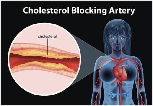 How to reduce cholesterol and open the hearts arteries
