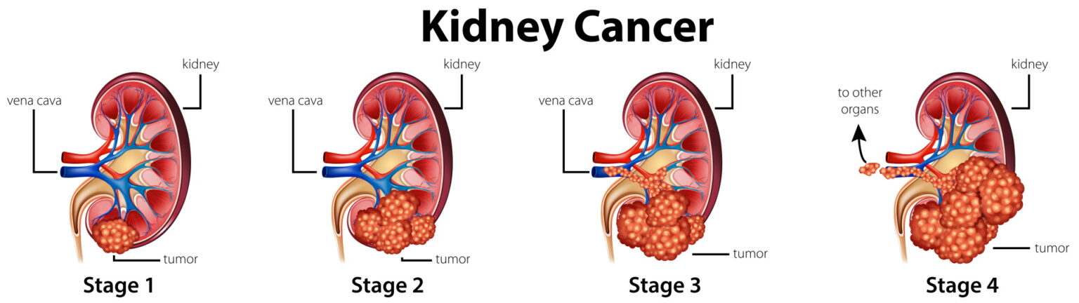 Renal Carcinoma Its Causes Signs Symptoms And Cure Kidney Cancer