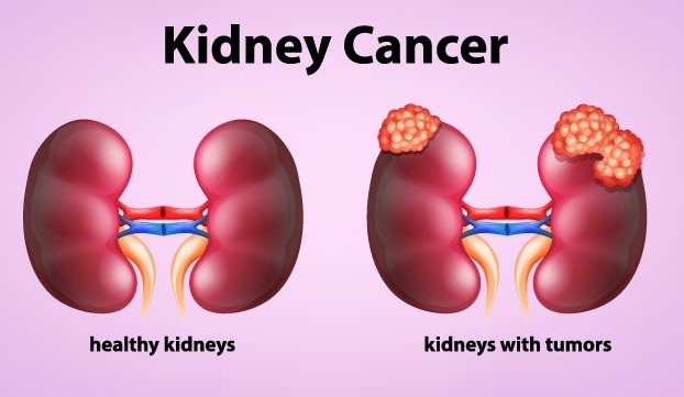 Kidney Cancer 800x465 5