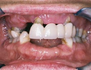 Dental care: Gum disease